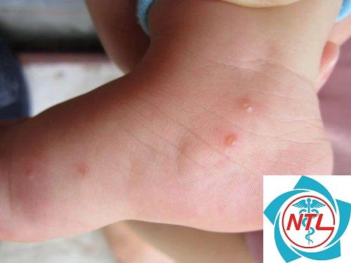 u mềm lây ở chân