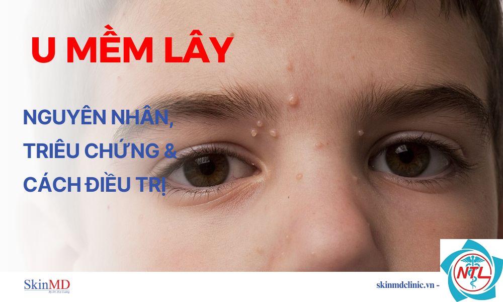 u mềm lây ở mặt - Image 5