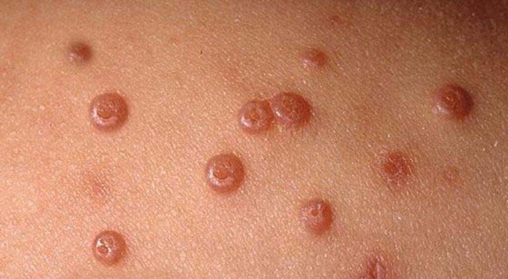 u mềm lây ở người lớn
