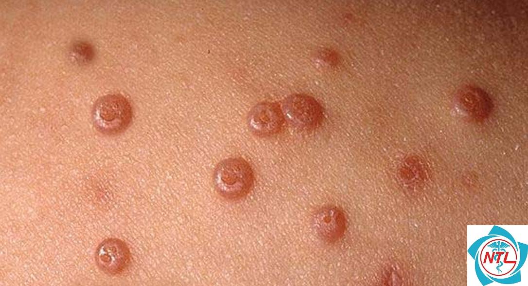 u mềm lây ở người suy giảm miễn dịch - Image 3