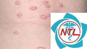 u mềm lây ở người suy giảm miễn dịch - Image 1