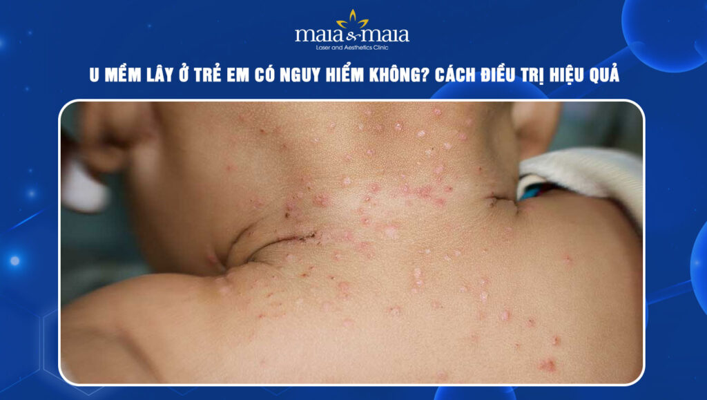 u mềm lây ở trẻ em