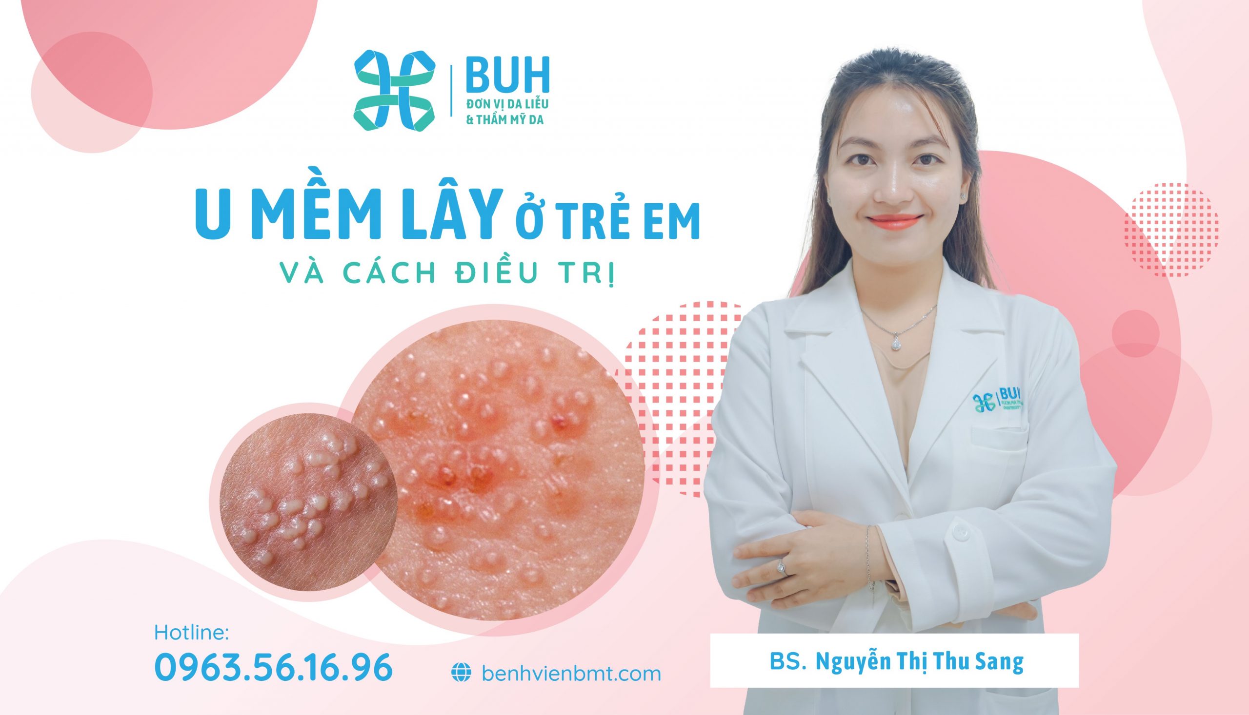 u mềm lây ở trẻ em - Image 2