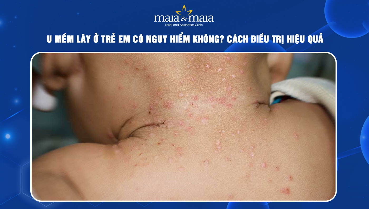 u mềm lây ở trẻ em - Image 1