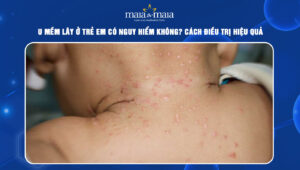 u mềm lây ở trẻ nhỏ