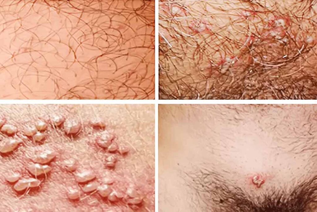 u mềm lây ở vùng sinh dục