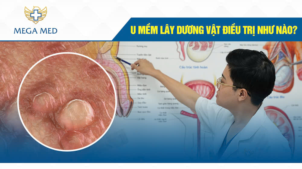 u mềm lây ở vùng sinh dục - Image 2
