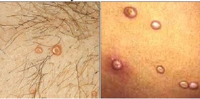 u mềm lây ở vùng sinh dục - Image 4