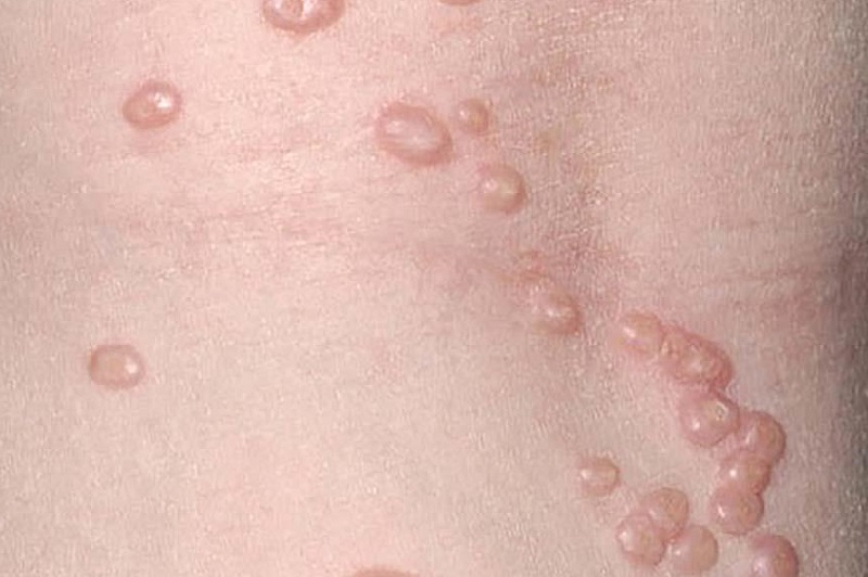 u mềm lây ở vùng sinh dục - Image 5
