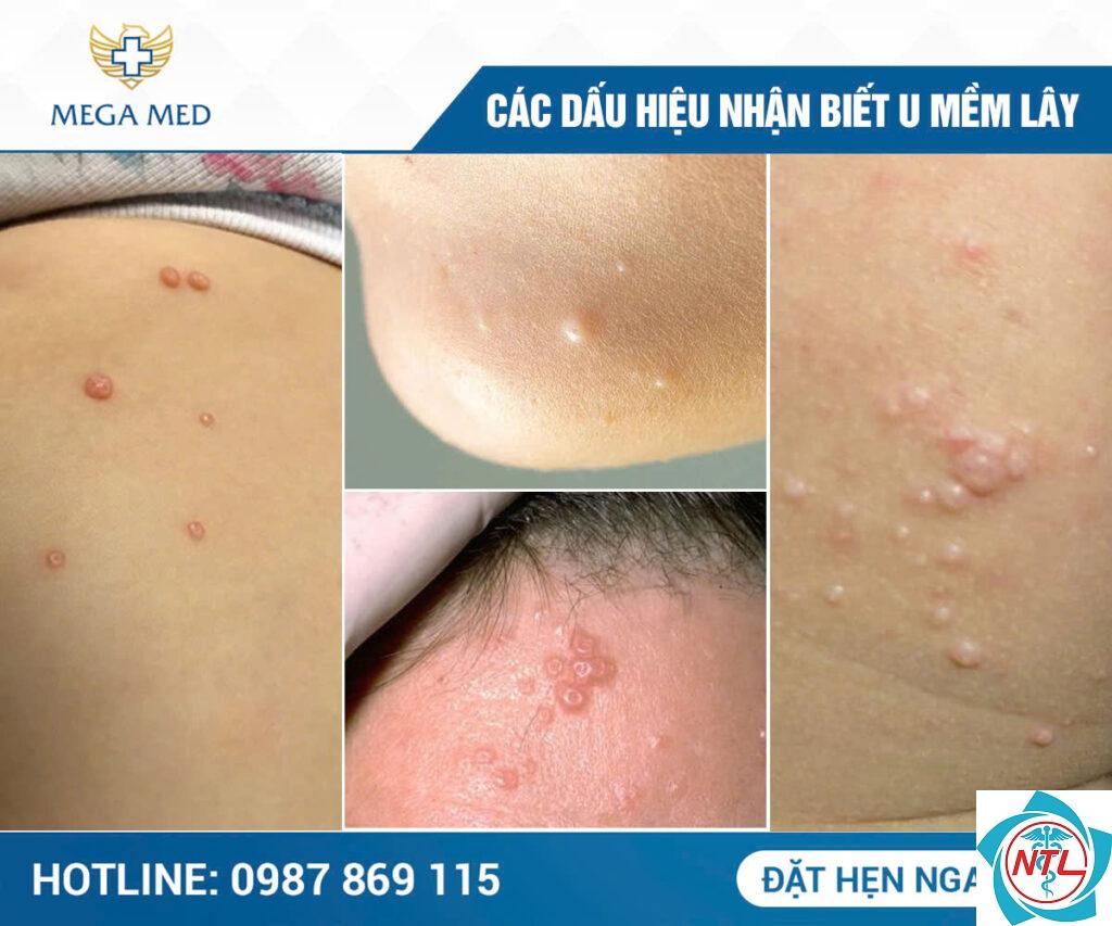 u mềm lây tái phát