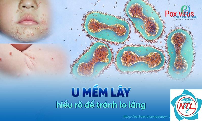 u mềm lây tái phát - Image 5