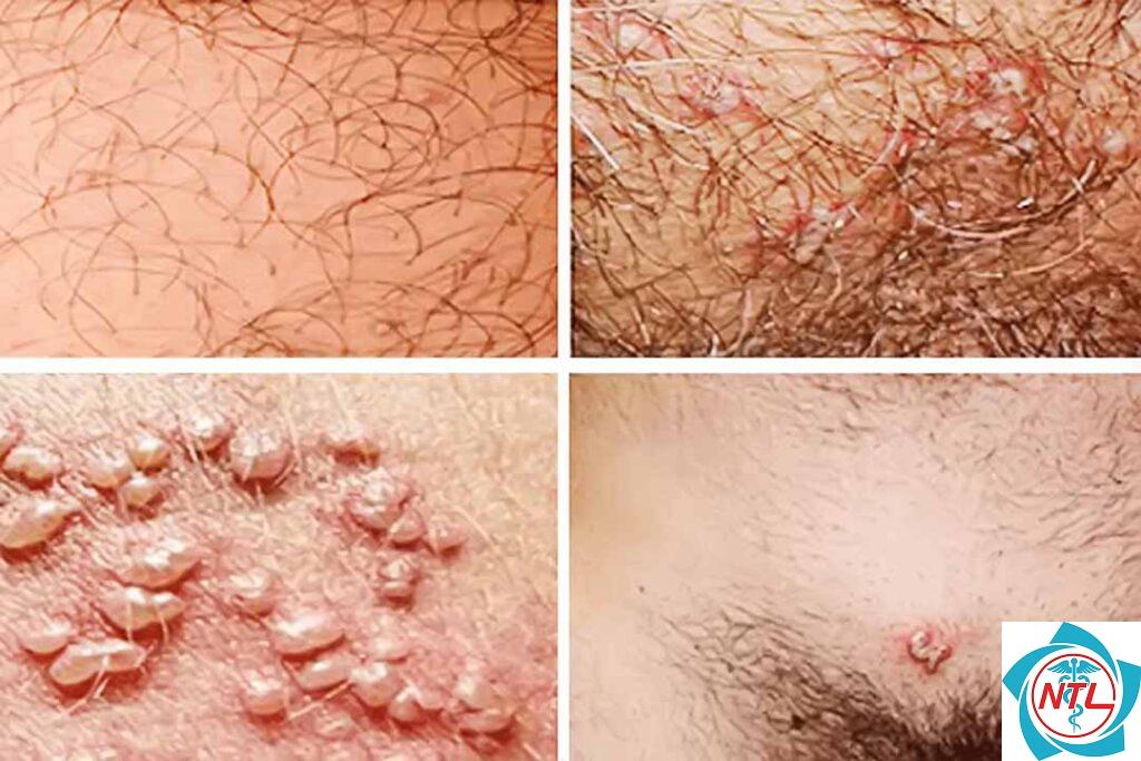 u mềm lây vùng sinh dục
