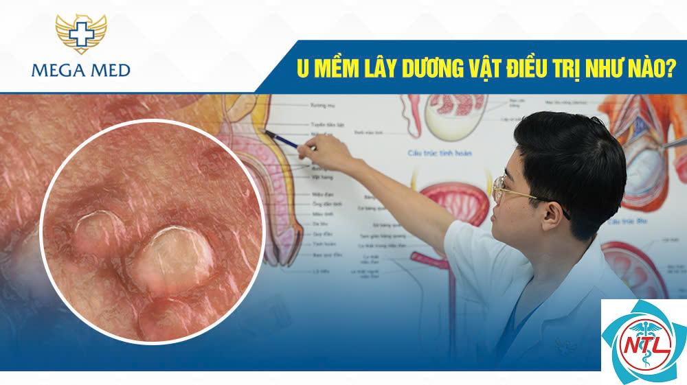 u mềm lây vùng sinh dục - Image 2