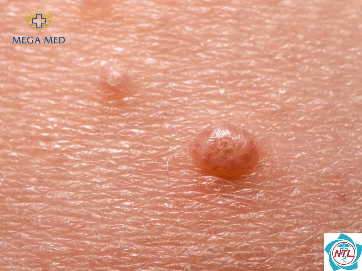 u mềm lây vùng sinh dục - Image 3