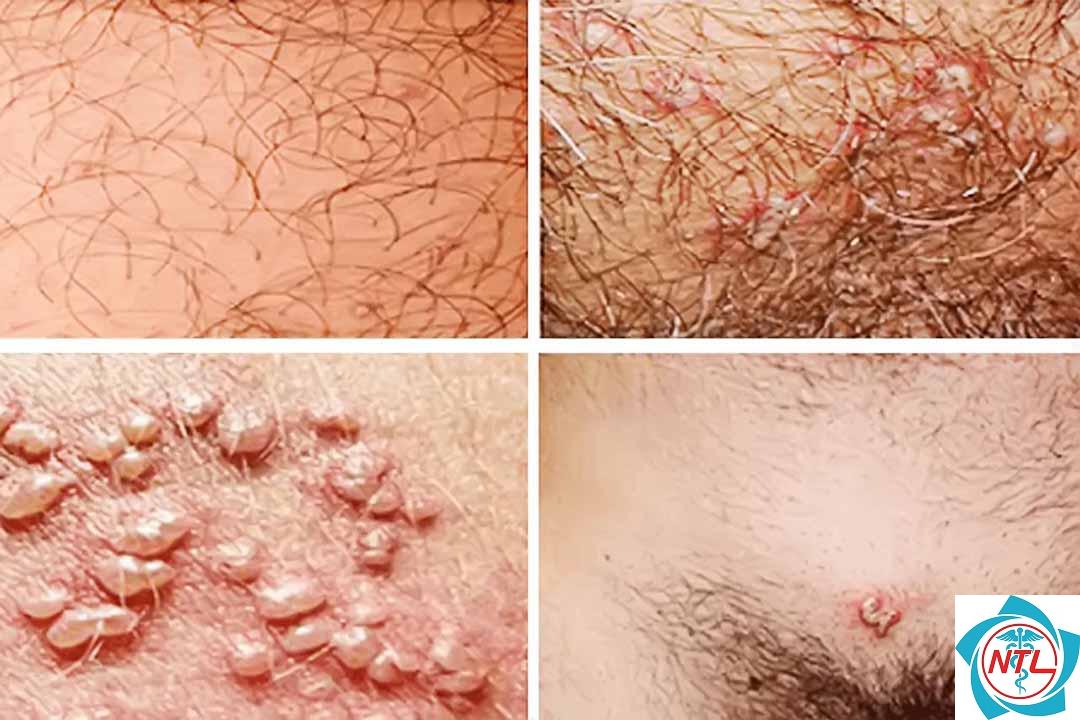u mềm lây vùng sinh dục - Image 1