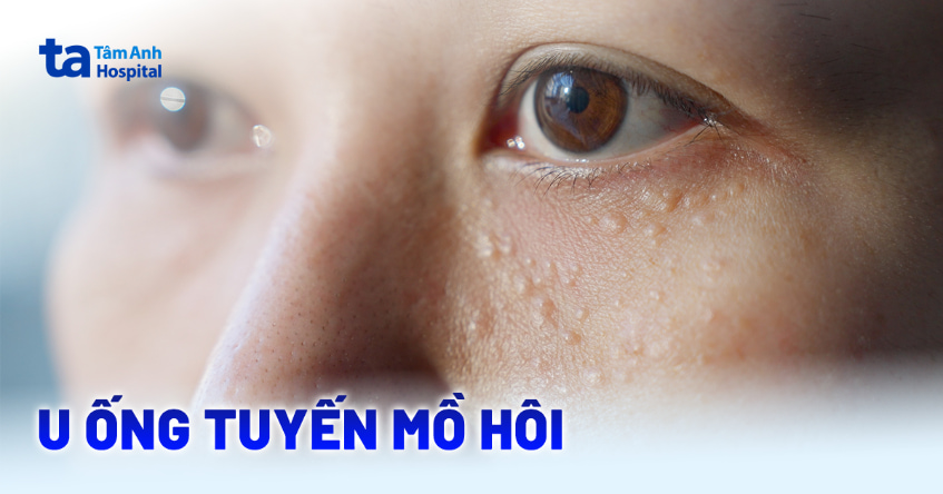 u tuyến mồ hôi - Image 5