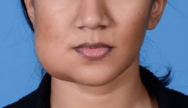 u xương hàm dưới - Image 3