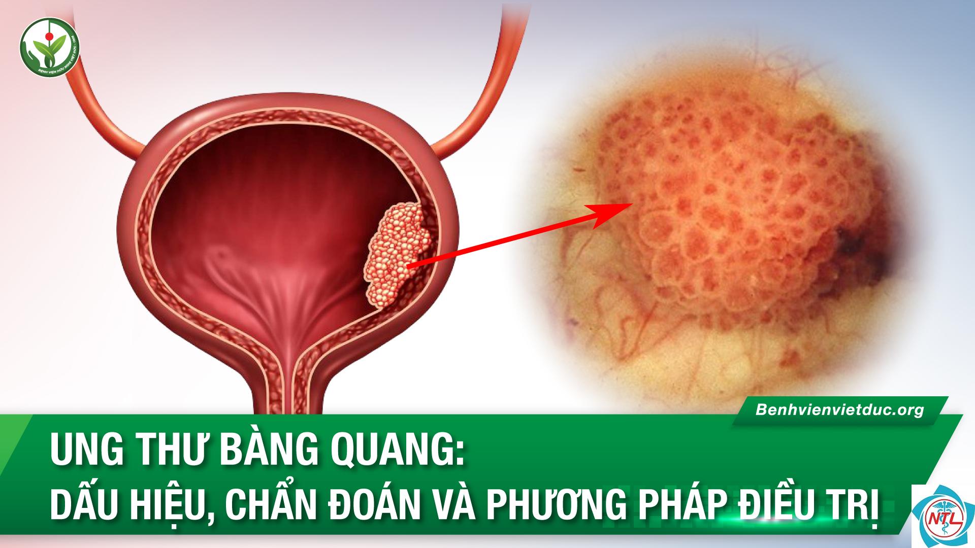 ung thư bàng quang - Image 2