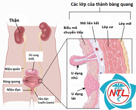 ung thư bàng quang cơ xâm lấn - Image 3