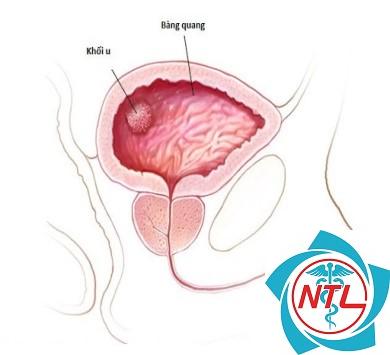 ung thư bàng quang không xâm lấn cơ - Image 4