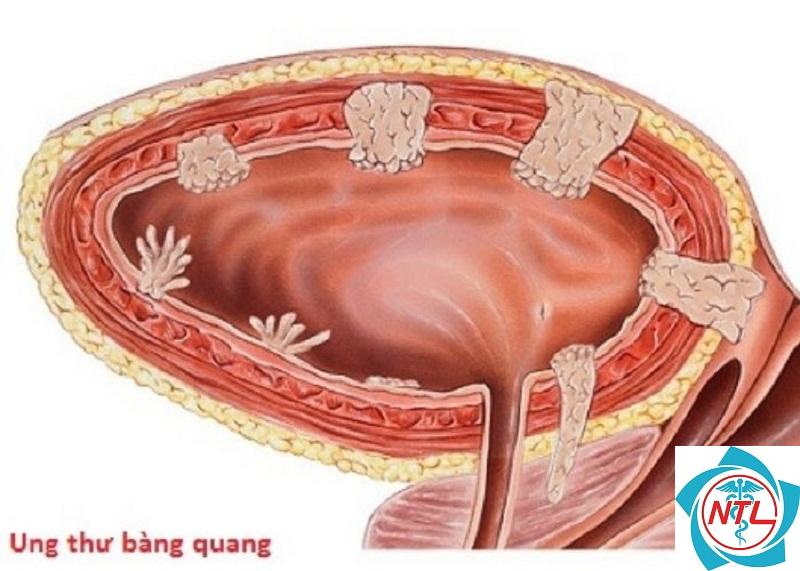 ung thư bàng quang ở nam giới - Image 2