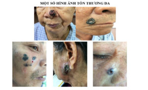 ung thư biểu mô tế bào đáy