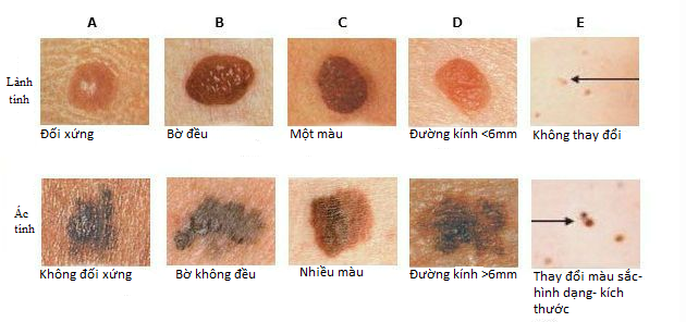 ung thư biểu mô tế bào đáy - Image 4