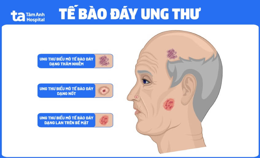 ung thư biểu mô tế bào đáy - Image 5