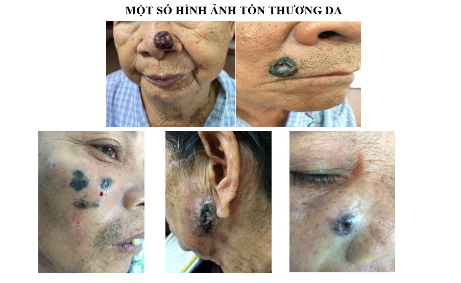 ung thư biểu mô tế bào đáy - Image 1