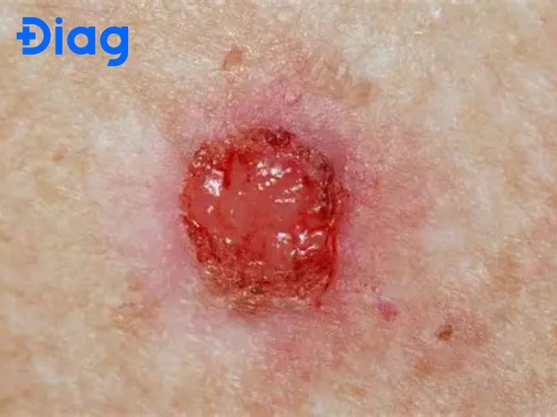 ung thư biểu mô tế bào vảy - Image 3