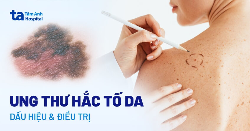 ung thư da hắc tố - Image 1