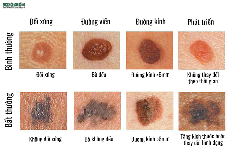 ung thư da hắc tố - Image 3