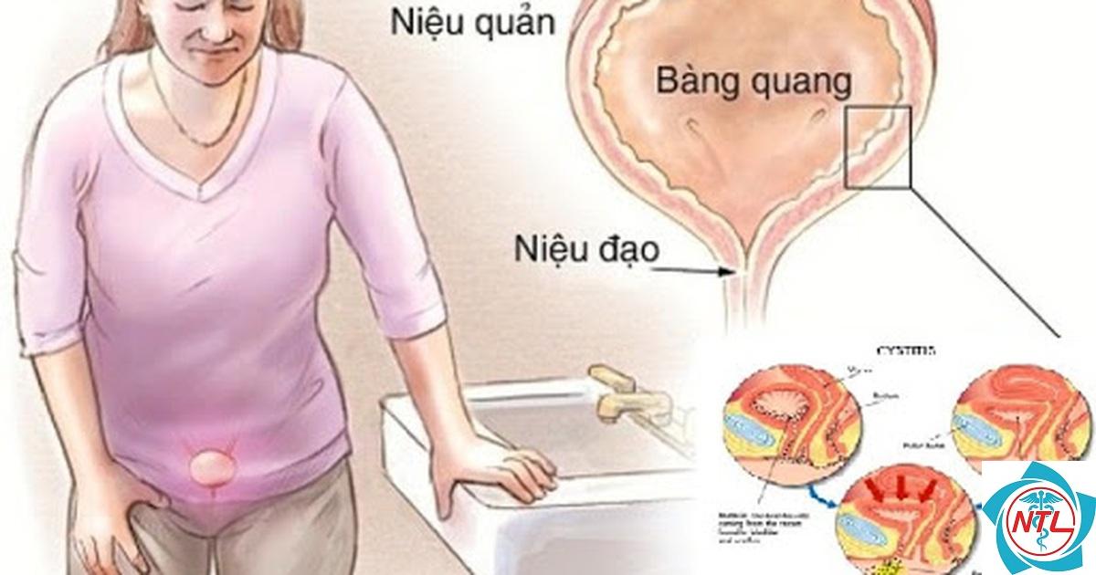 ung thư niệu đạo - Image 2