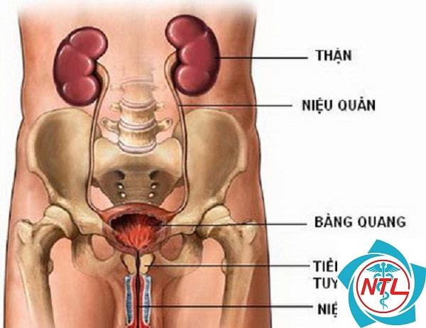 ung thư niệu quản - Image 2