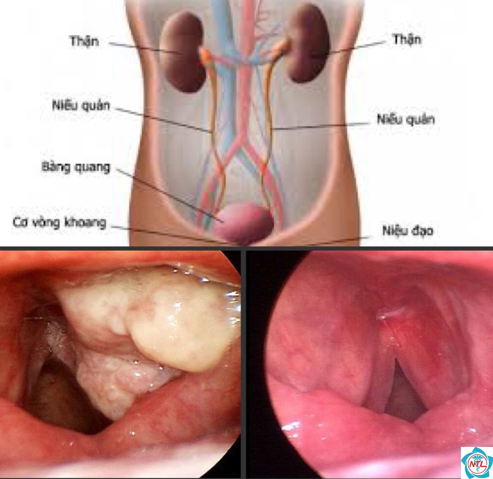 ung thư niệu quản - Image 3