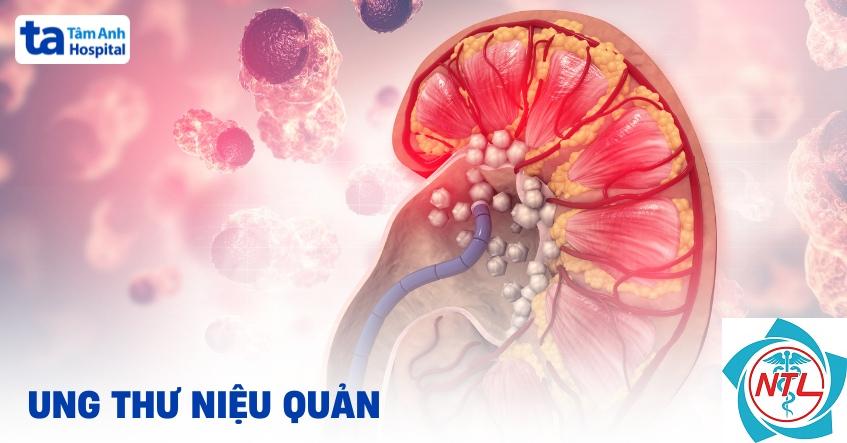 ung thư niệu quản - Image 4
