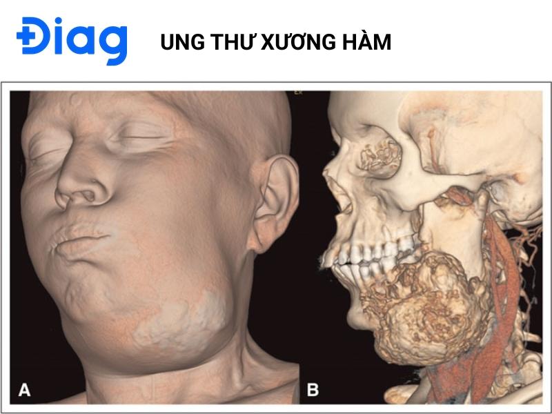 ung thư quai hàm - Image 3