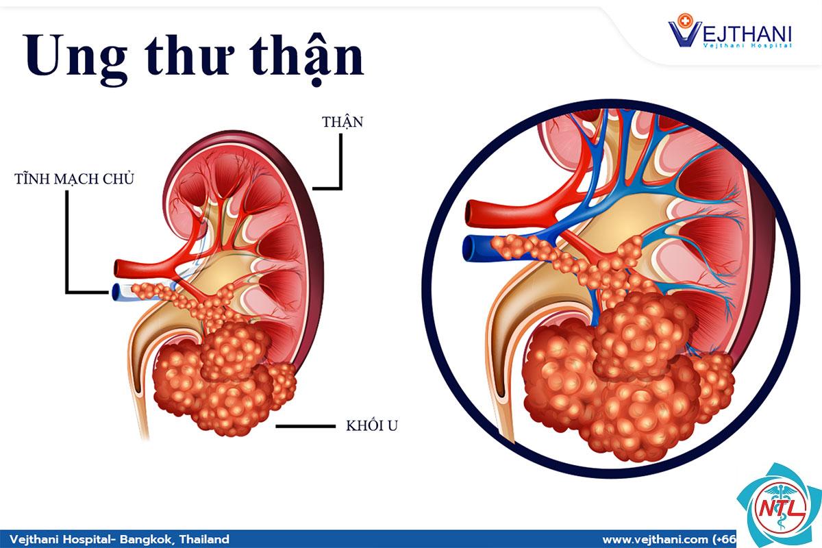 ung thư thận - Image 4