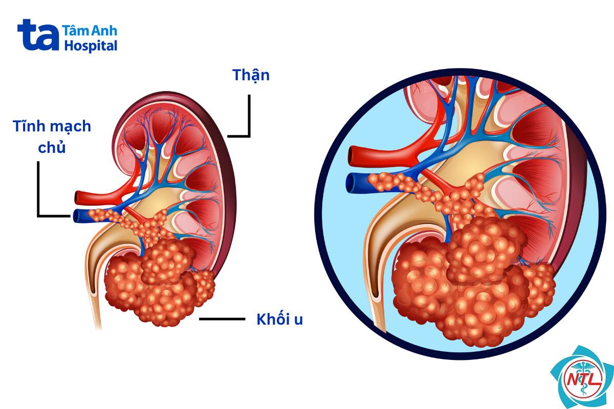 ung thư thận dạng nhú - Image 4