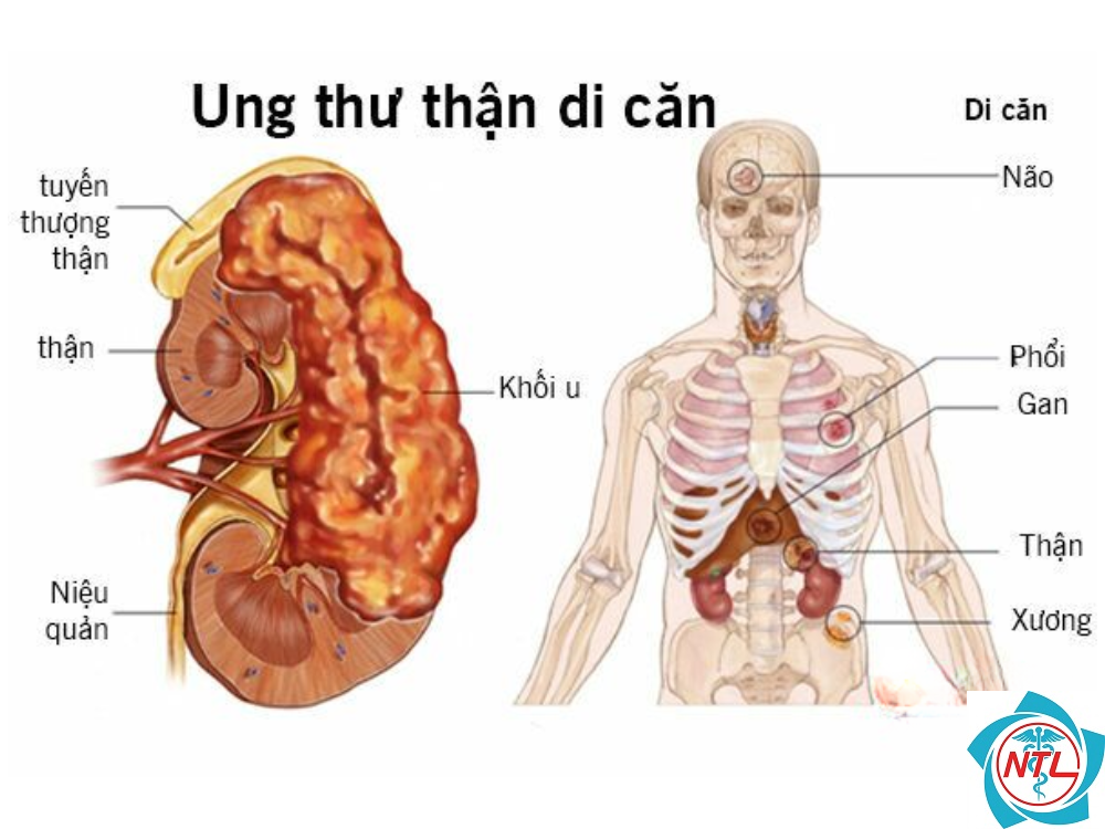 ung thư thận di căn