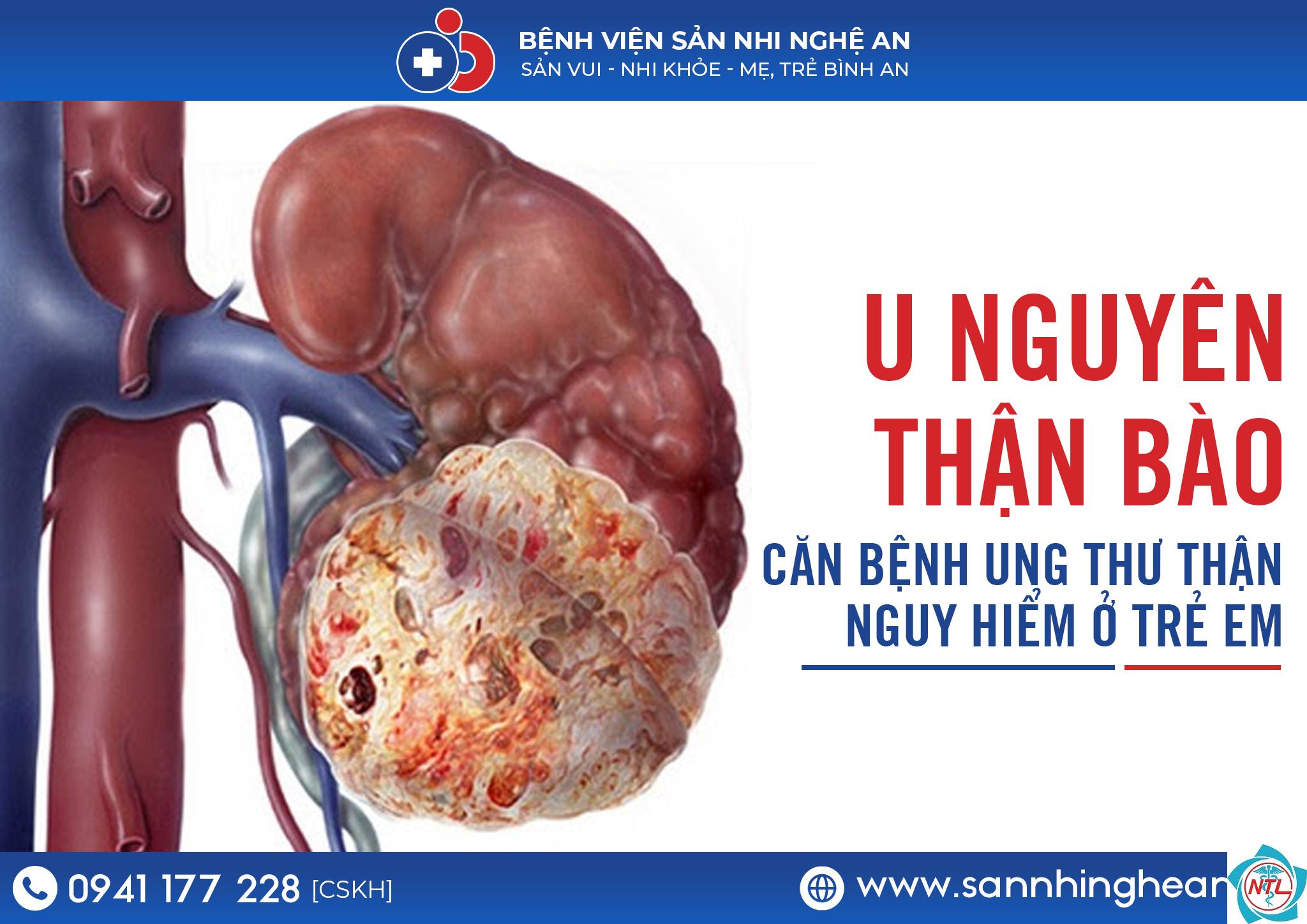 ung thư thận ở trẻ em - Image 2