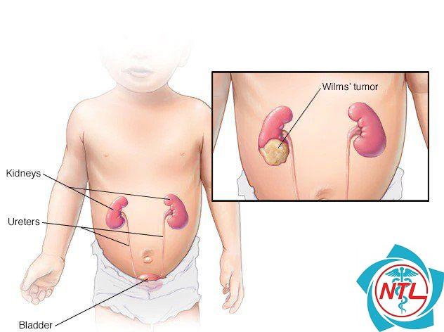ung thư thận ở trẻ em