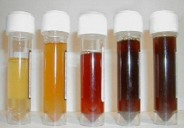 vàng da kèm nước tiểu sẫm màu - Image 3