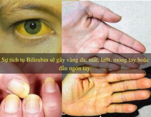 vàng da là dấu hiệu bệnh gì