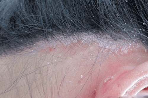 vảy nến da đầu và gàu - Image 3