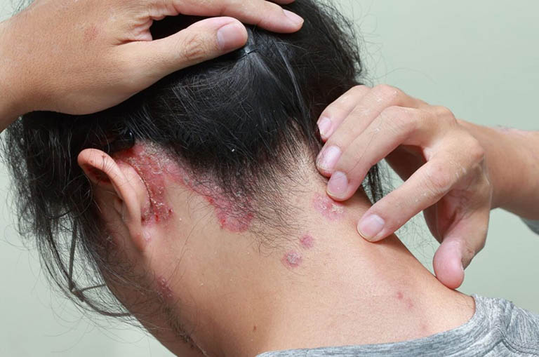 vảy nến da đầu và gàu - Image 4