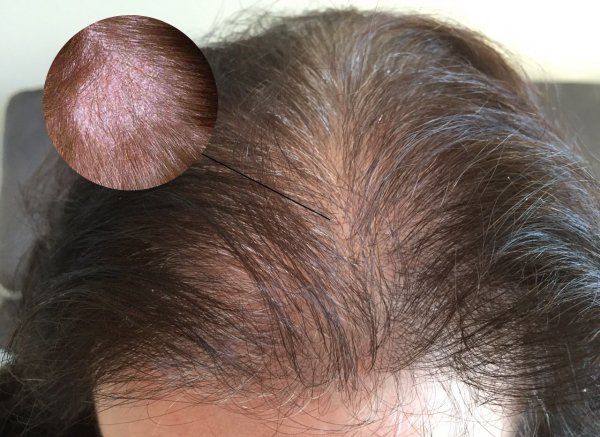 vảy nến da đầu và gàu - Image 5