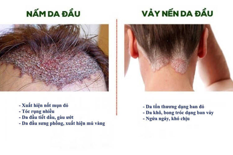 vảy nến da đầu và gàu