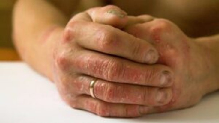 vảy nến ở người cao tuổi