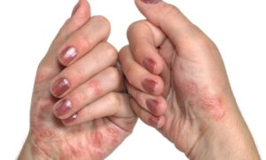 vảy nến ở tay